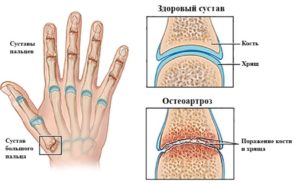 Почему болят суставы пальцев рук?