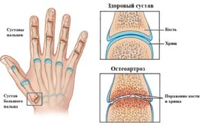 Артроз кистей рук