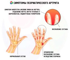 Симптомы псориатического артрита ногтей