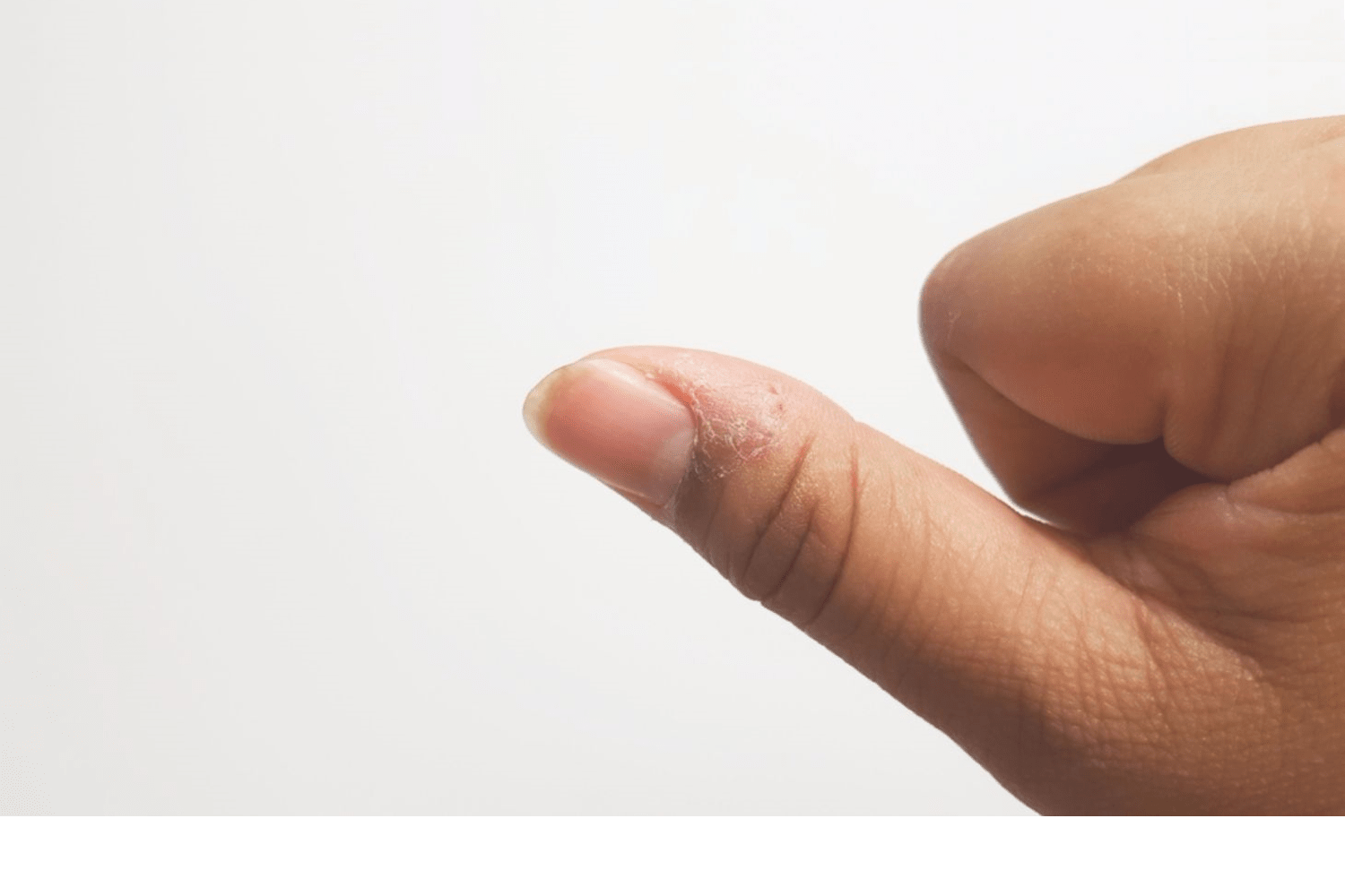 Паронихия пальца на руке после маникюра – что делать?