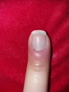 Лечение паронхии (воспаления пальца возле ногтя)