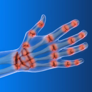 Причины развития артроза кистей рук
