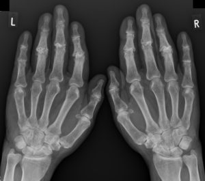 Рентген кистей рук для диагностики артроза