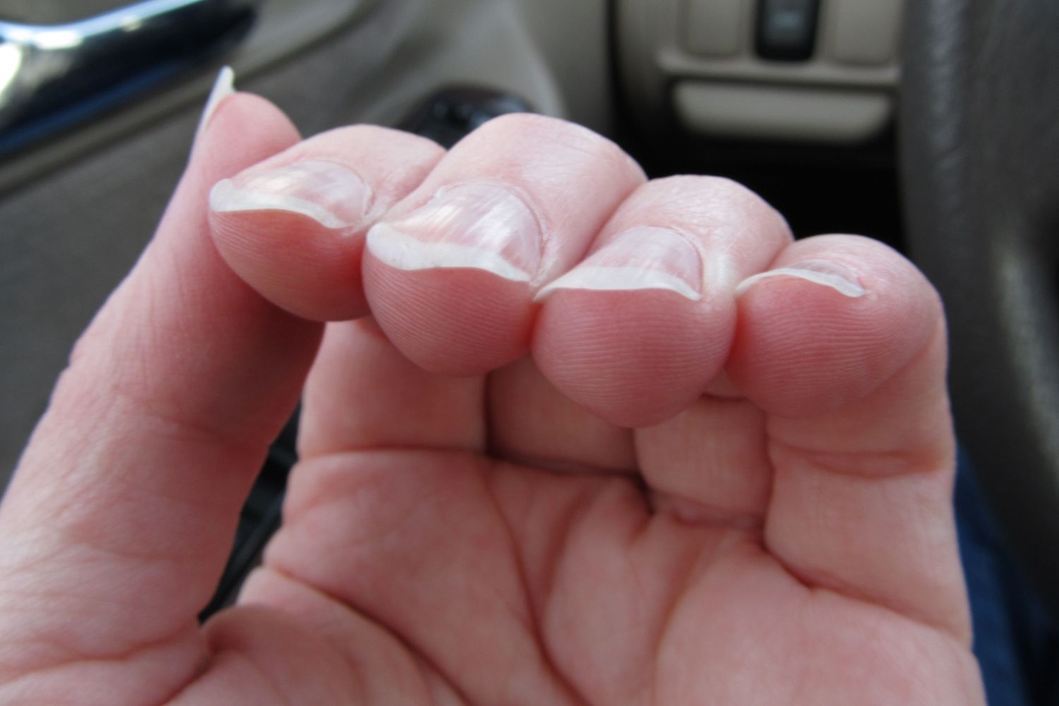 Кривые ногти – почему возникает проблема и как ее устранить