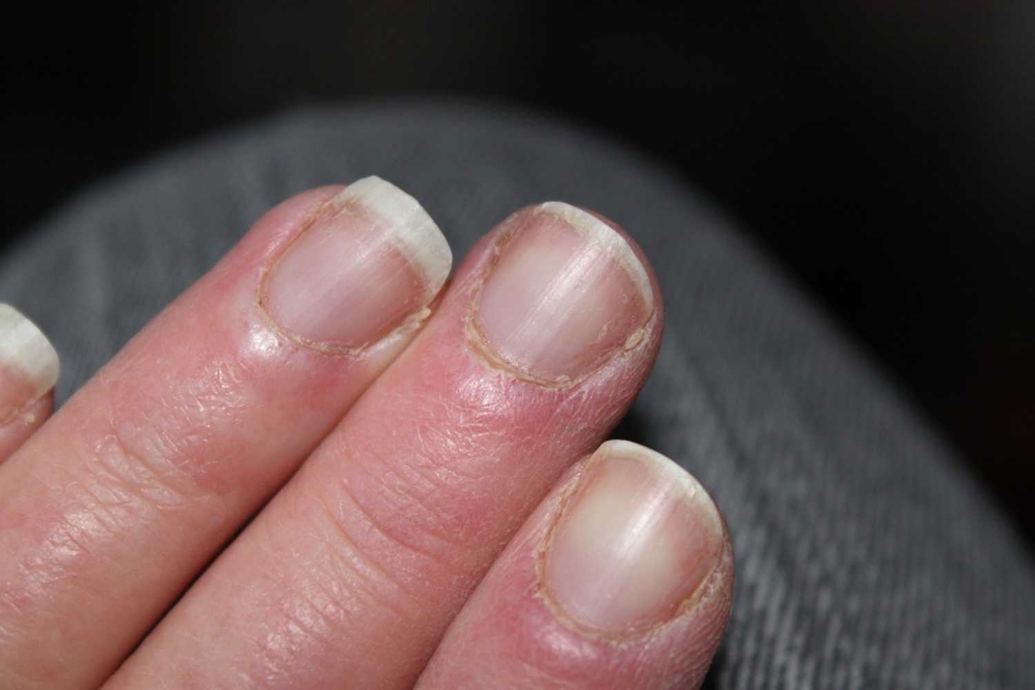 Как лечить заусенцы на пальцах – причины появления, профилактика