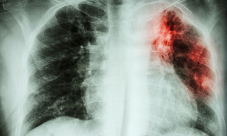 Ob svetovnem dnevu tuberkuloze pozivi k odpravi bolezni