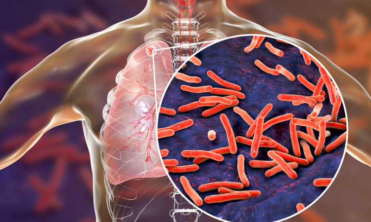 Kaj je tuberkuloza?