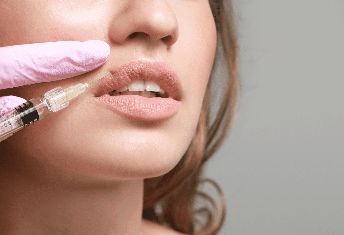 5 Fakten über Lip Filler