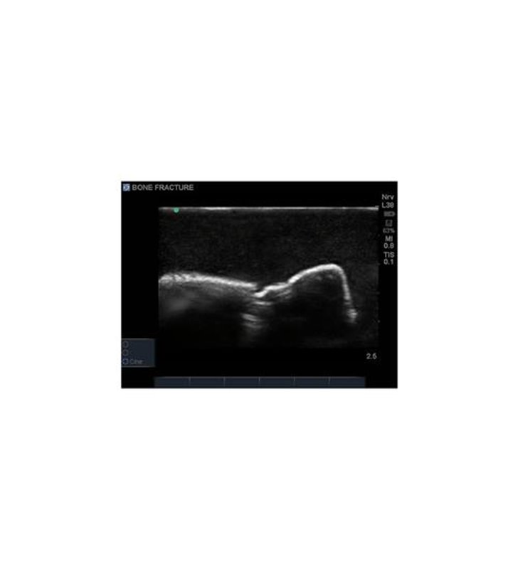 Model de formare cu ultrasunete, fractura osoasa Blue Phantom - Crepitus