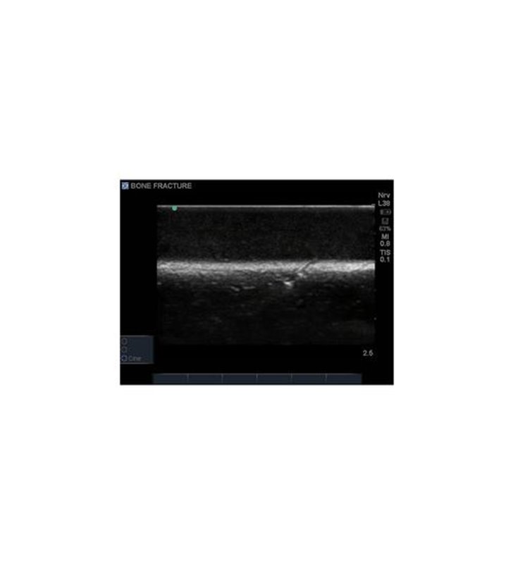 Model de formare cu ultrasunete, fractura osoasa Blue Phantom - Crepitus