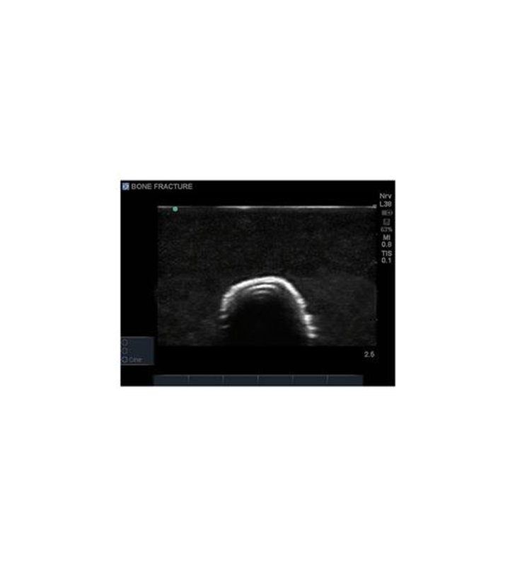 Model de formare cu ultrasunete, fractura osoasa Blue Phantom - Crepitus
