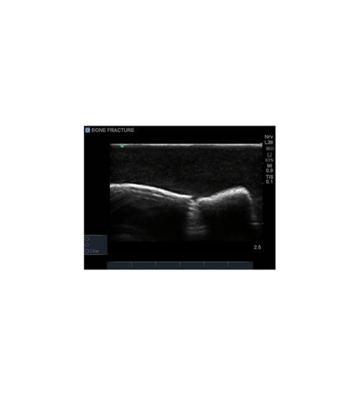Model de formare cu ultrasunete, fractura osoasa Blue Phantom - Crepitus