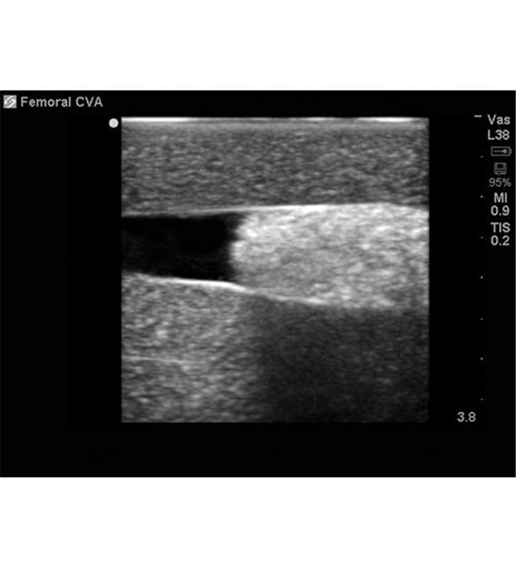 Țesut de înlocuire a accesului vascular femural pentru BPP-031 până la BPP-036 Blue Phantom
