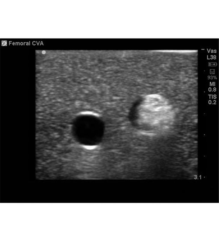 Țesut de înlocuire a accesului vascular femural pentru BPP-031 până la BPP-036 Blue Phantom