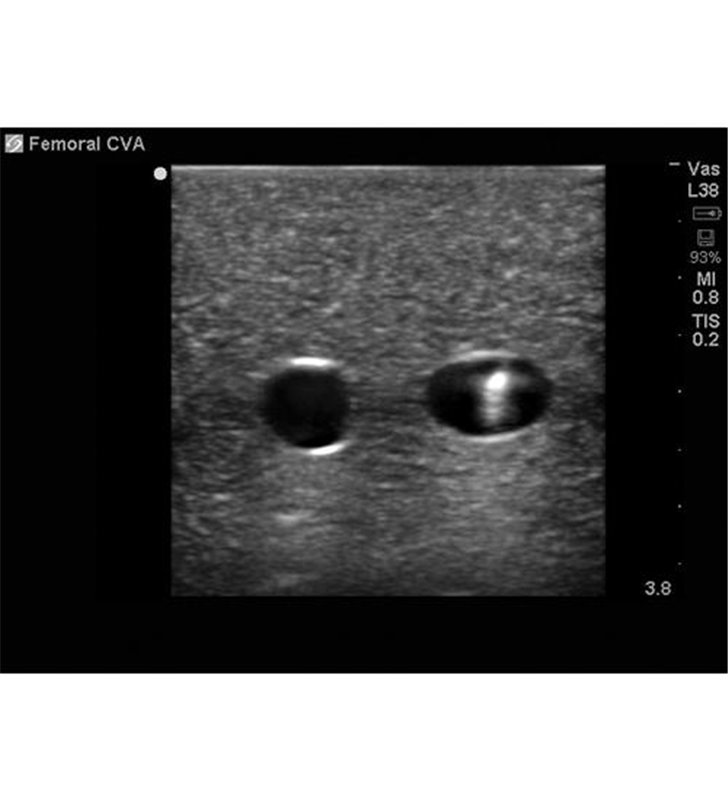 Țesut de înlocuire a accesului vascular femural pentru BPP-031 până la BPP-036 Blue Phantom