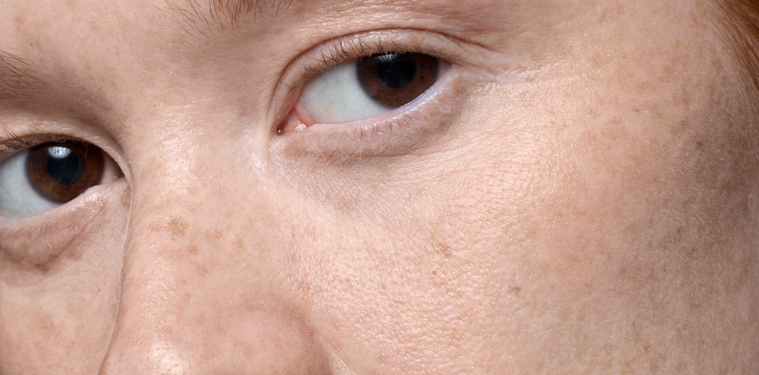 Как убрать пигментацию на лице?