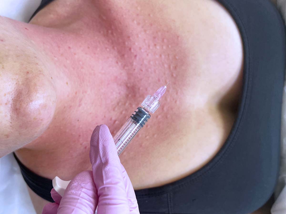 Этап восстановления после биоревитализации