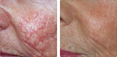 //cdn.optipic.io/site-106815/issues/lazery-dlya-korrektsii-sosudov/удаление сосудов 3.jpg