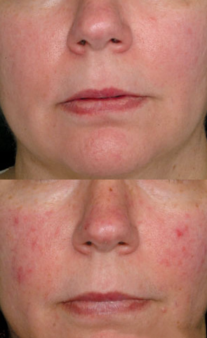 //cdn.optipic.io/site-106815/issues/lazery-dlya-korrektsii-sosudov/коррекция сосудов.png