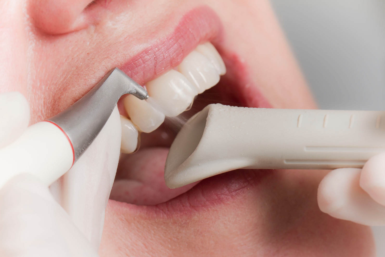 Что такое профессиональная гигиена полости рта?