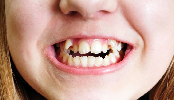 Зачем выравнивать "кривые" зубы?