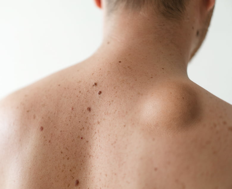 Удаление липомы