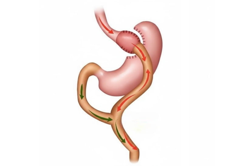 Шунтирование (гастрарное шунтирование)