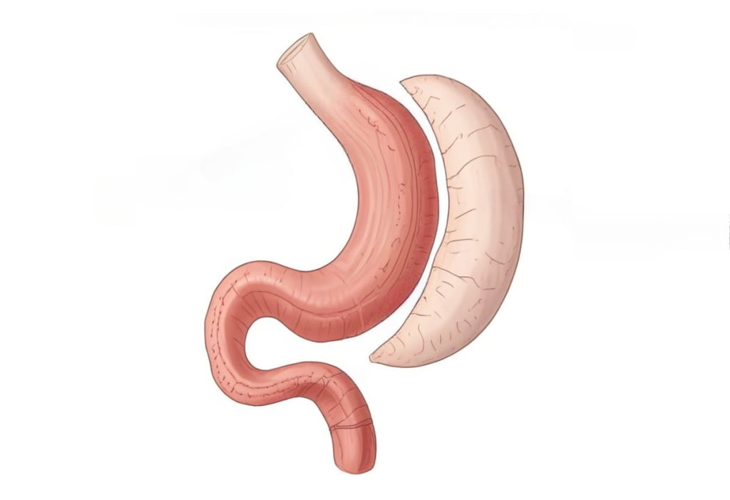 резекция желудка