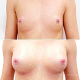 Увеличение груди 