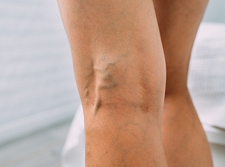 Кому необходим чекап «Здоровые сосуды»